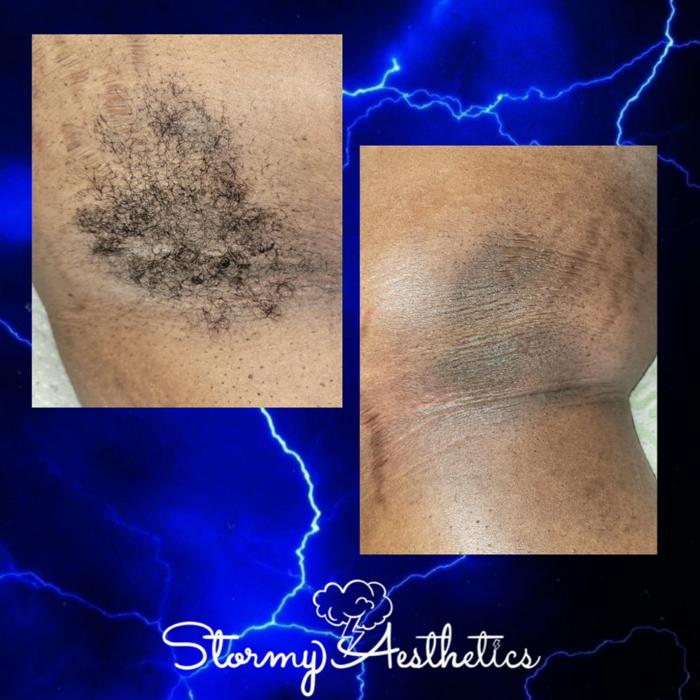 Underarm Wax at Stormy Aesthetics in Clearwater, FL