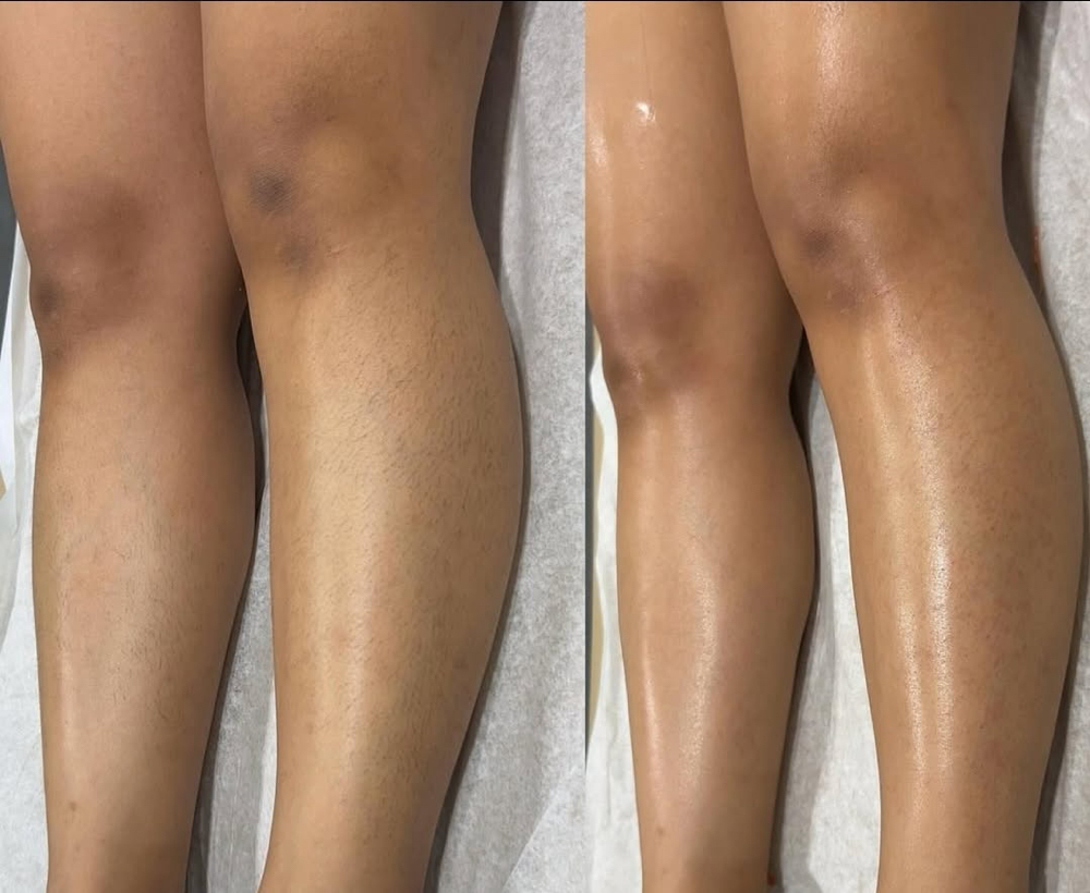 Lower Legs Hair Removal