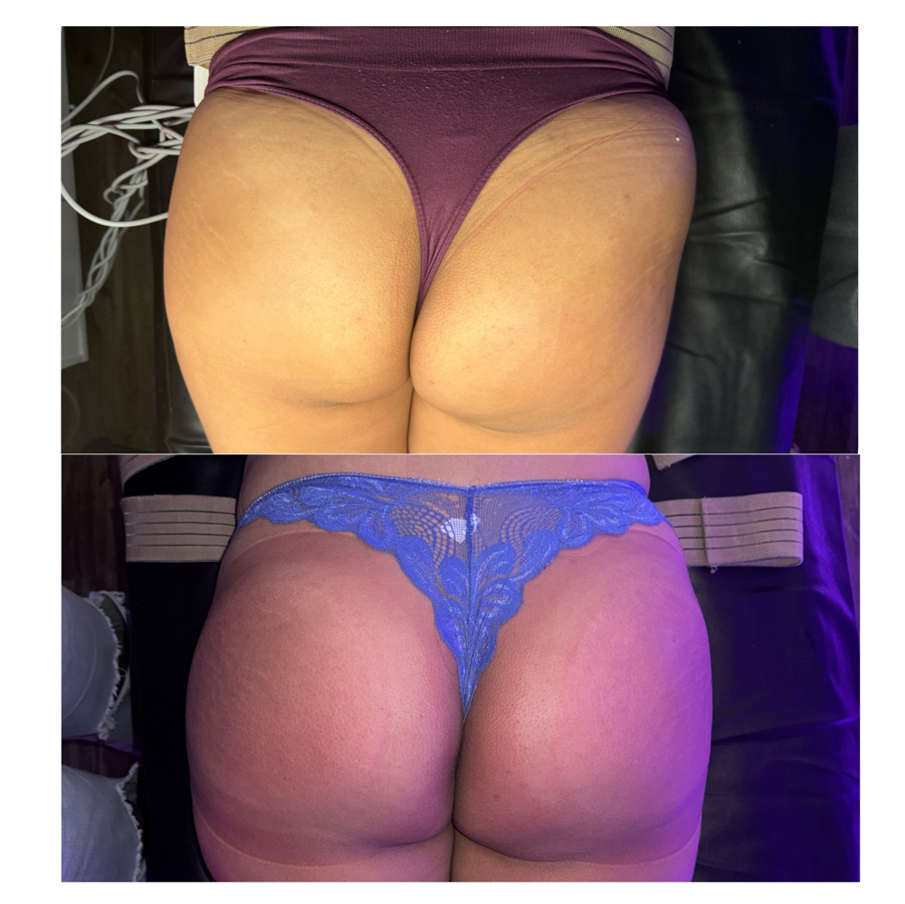 Booty Enhancement