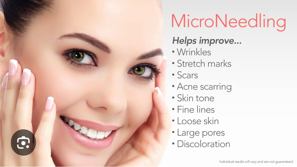 Microneedling Sale