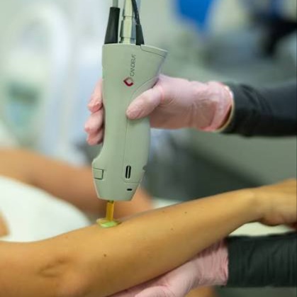 Half Arms at Illumina Aesthetics and Laser in Palm Beach Gardens, FL