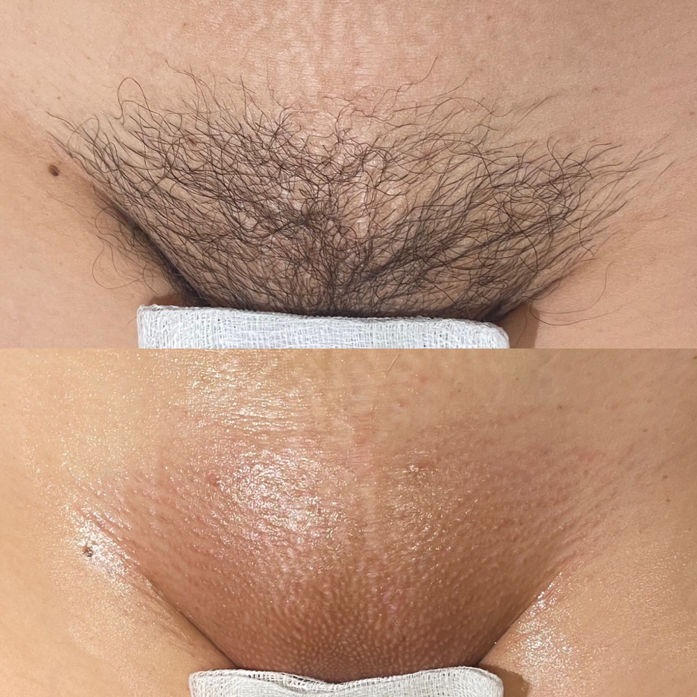Brazilian Wax