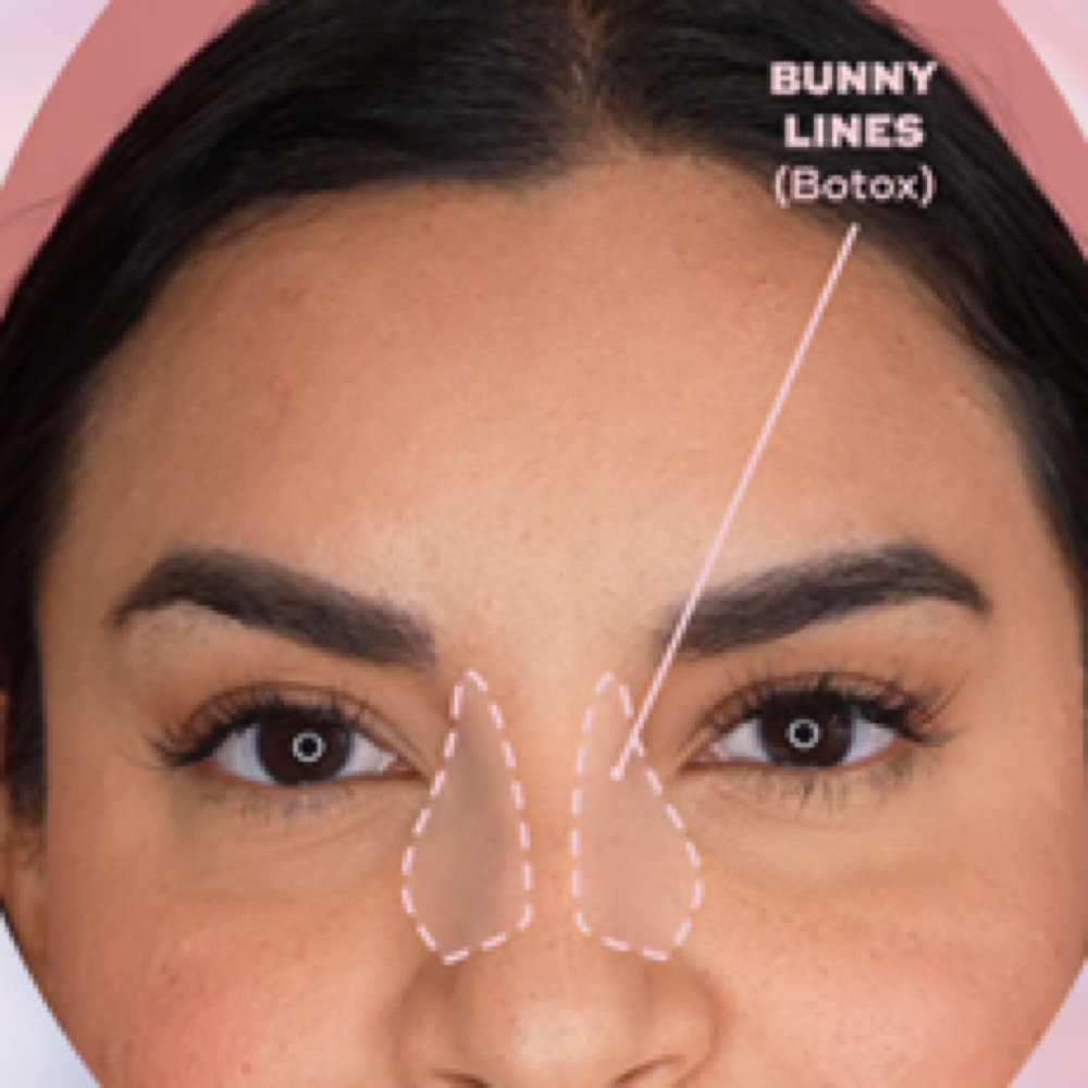 Bunny Lines Botox at Finesse Sculpt Body Studio in Parkville, MD
