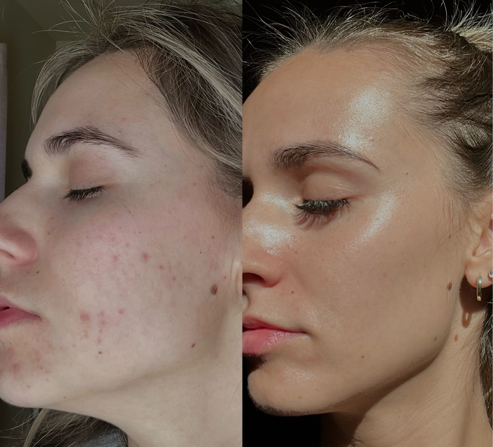 Acne Bootcamp treatment