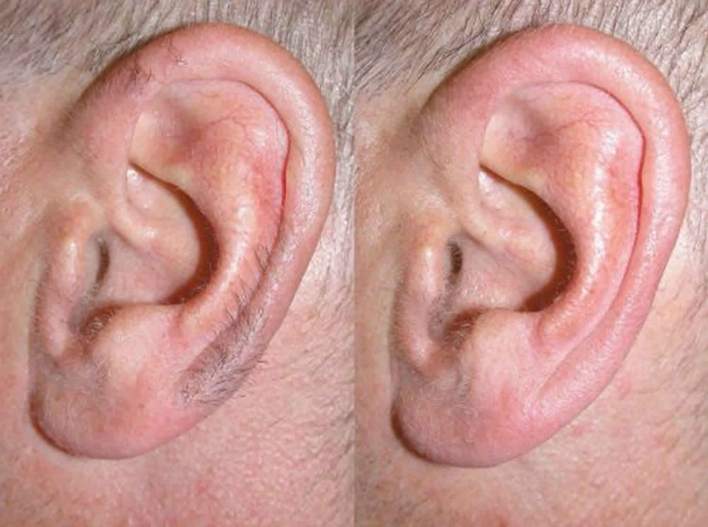 WAX - EAR