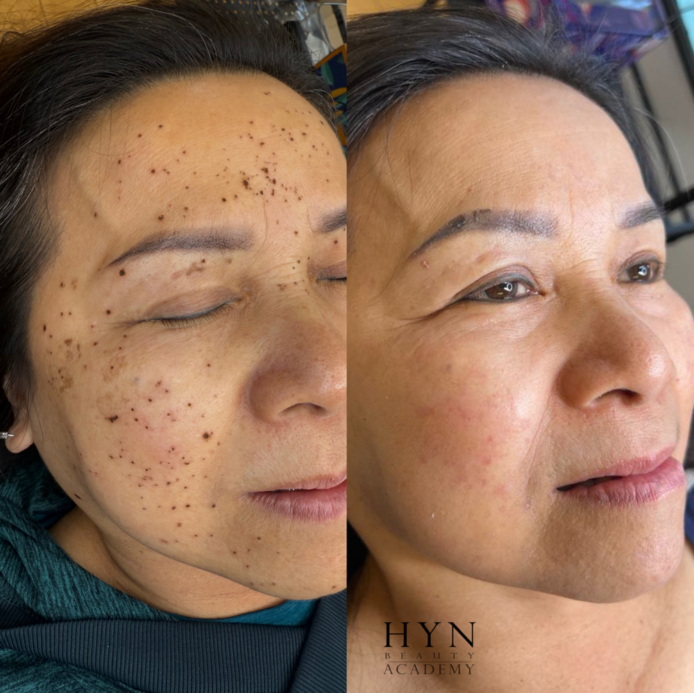 Dark Spot Removal