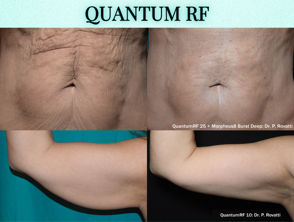 Free Quantum RF Consultaion