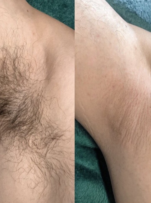 Underarm Waxing