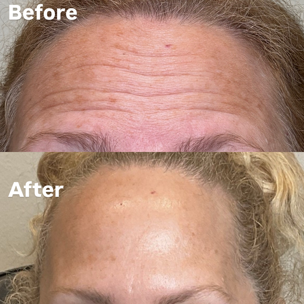 Botox(Dysport) at Beauty Goals Medspa & Wellness in Frisco, TX