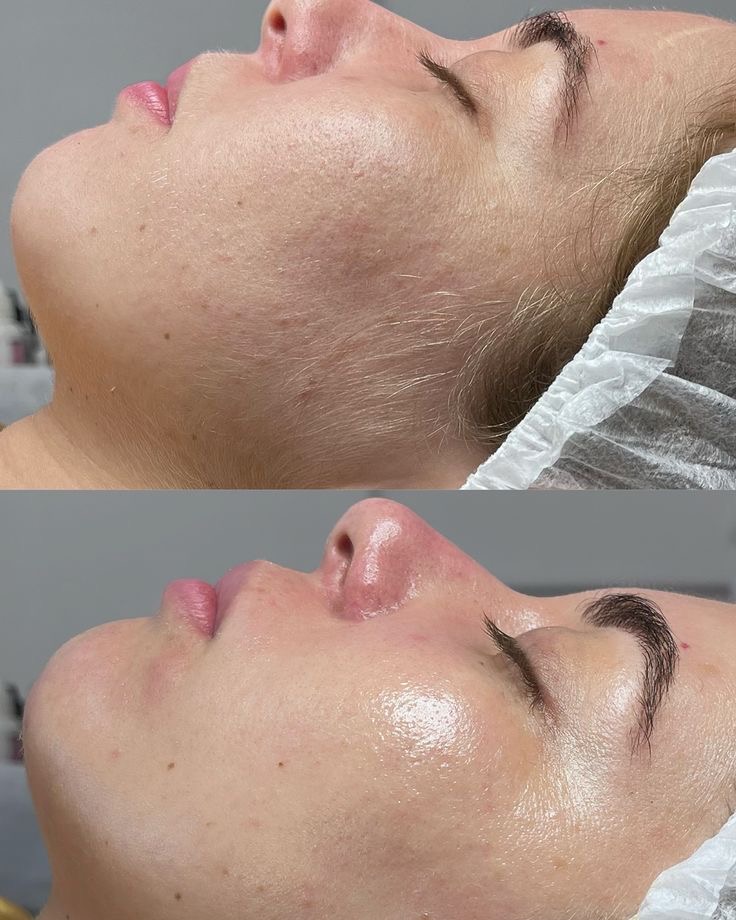 Dermaplaning