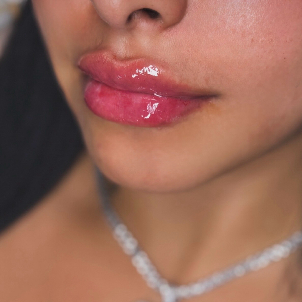 Russian Doll Lip Filler at Maurika Beauty in Jacksonville, FL
