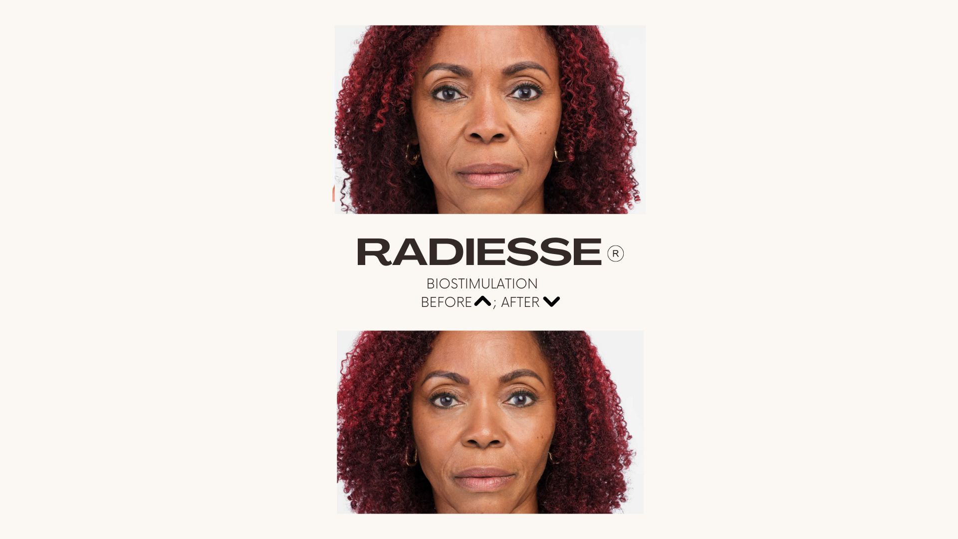 Radiesse®