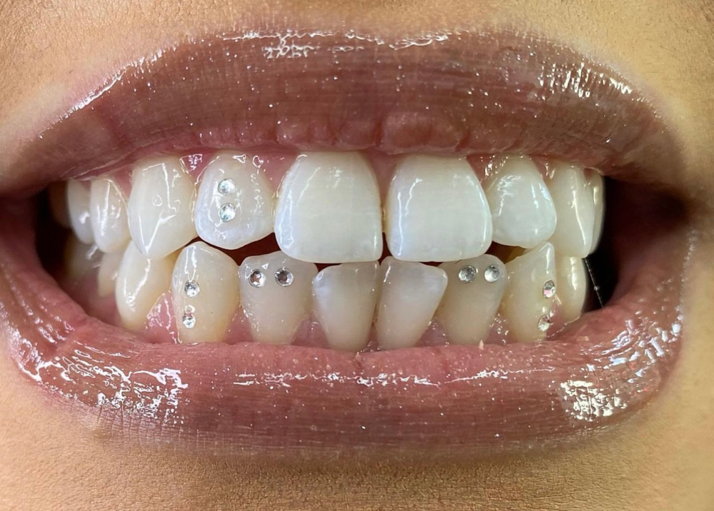 Tooth Gem