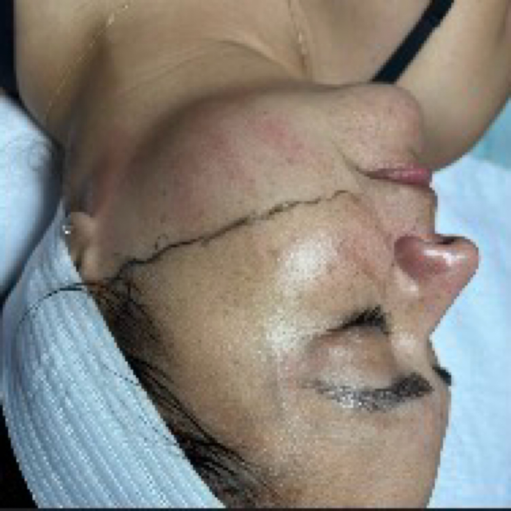 Dermaplane + enzyme at Beauty And Body in San Dimas, CA