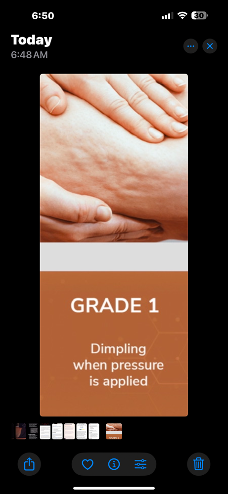 Grade 1 Cellulite 8 Session Pkg