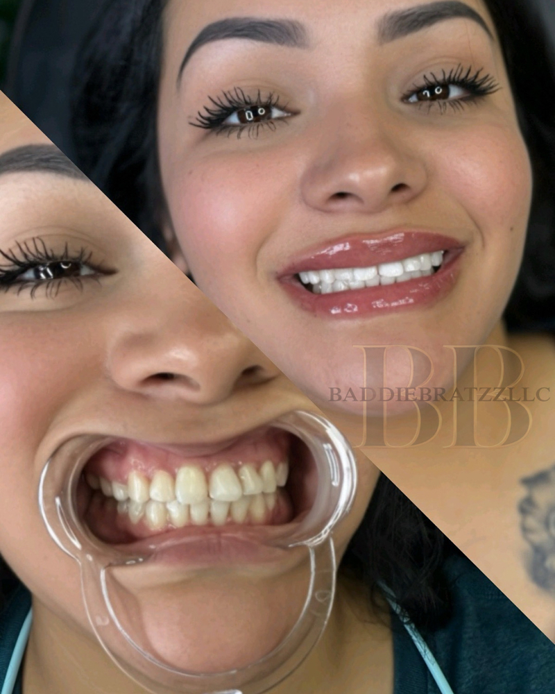 30 Minutes Teeth Whitening