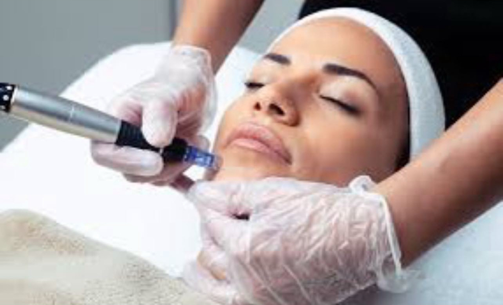 Microneedling [Very Small Area]