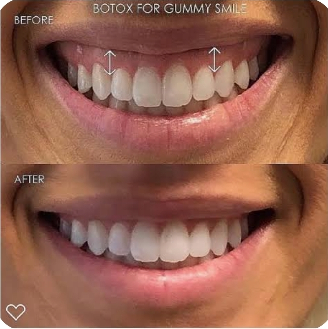 Lip Flip at Pin Me Aesthetics PLLC in Alvin, TX