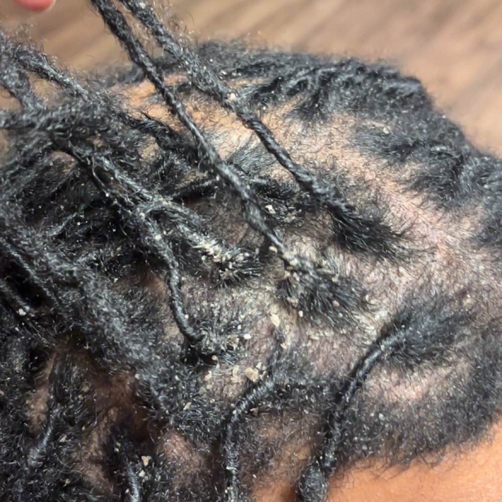 Dandruff Removal & Moisture Coating at KayKreationz in Charlotte, NC