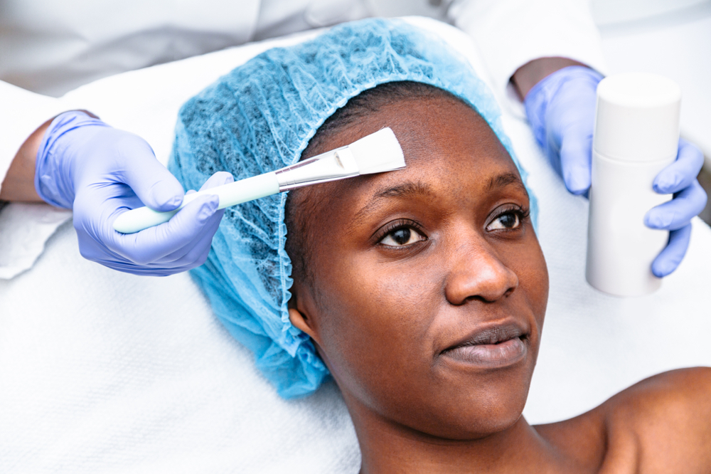 Chemcial Peels