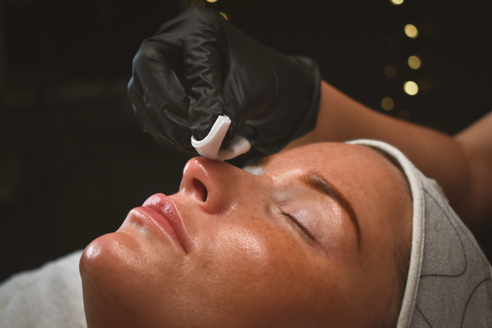 SUPERFICAL CHEMICAL PEEL