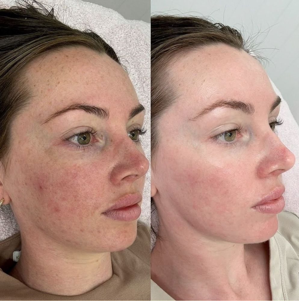Green Sea Peel at The Full Edit Aesthetic Studio in Florence, AL