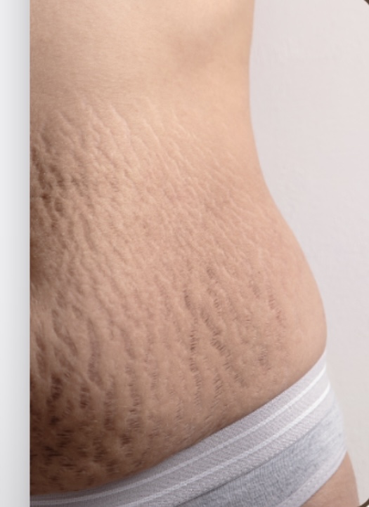 Inkless Stretch Mark Revision