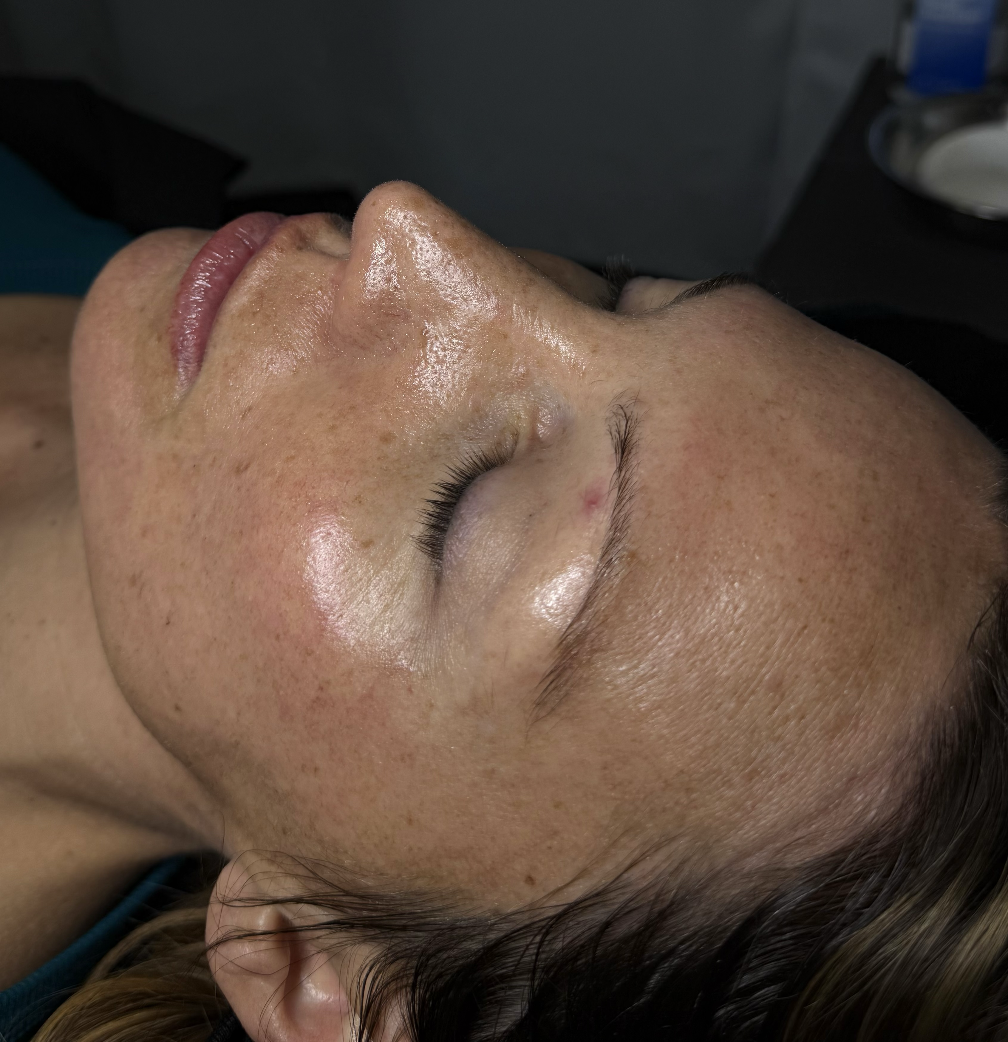 Acne Facial