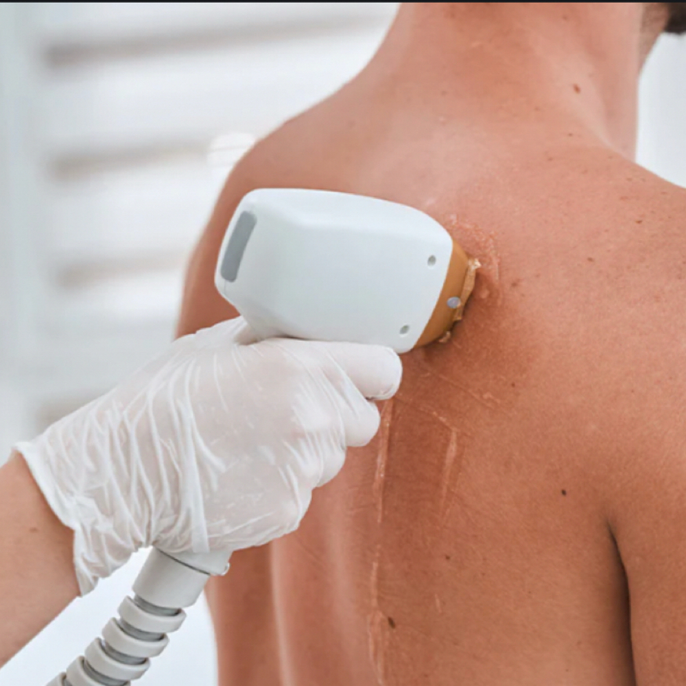 Laser Half Back at Loba Beauty Spa in Paterson, NJ