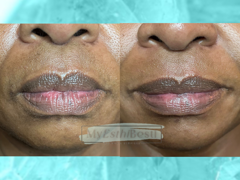 Lip + Chin Wax
