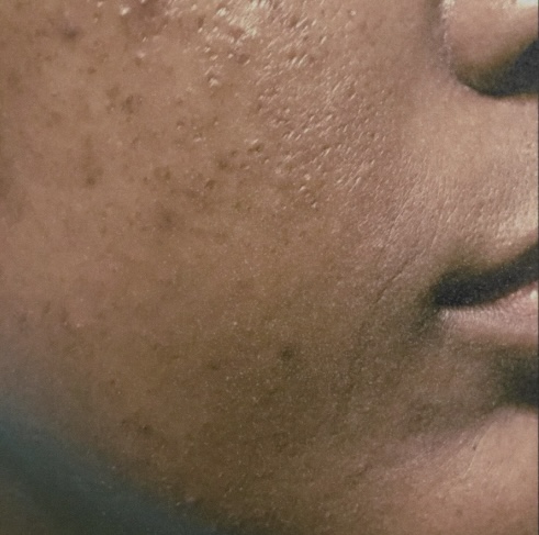 TREATMENT III: REFINE at VNTGE ESTÉ in Charlotte, NC