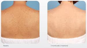 IPL/Photo Rejuvenation / Upper Back