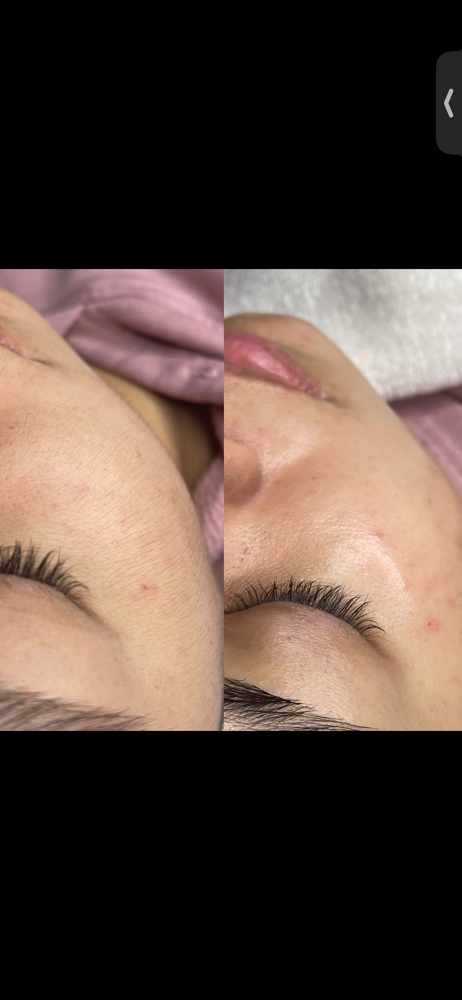 Dermaplane Facial