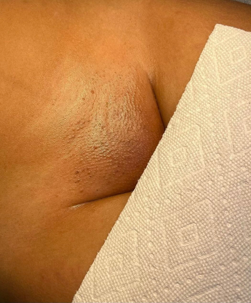Brazilian Sugaring