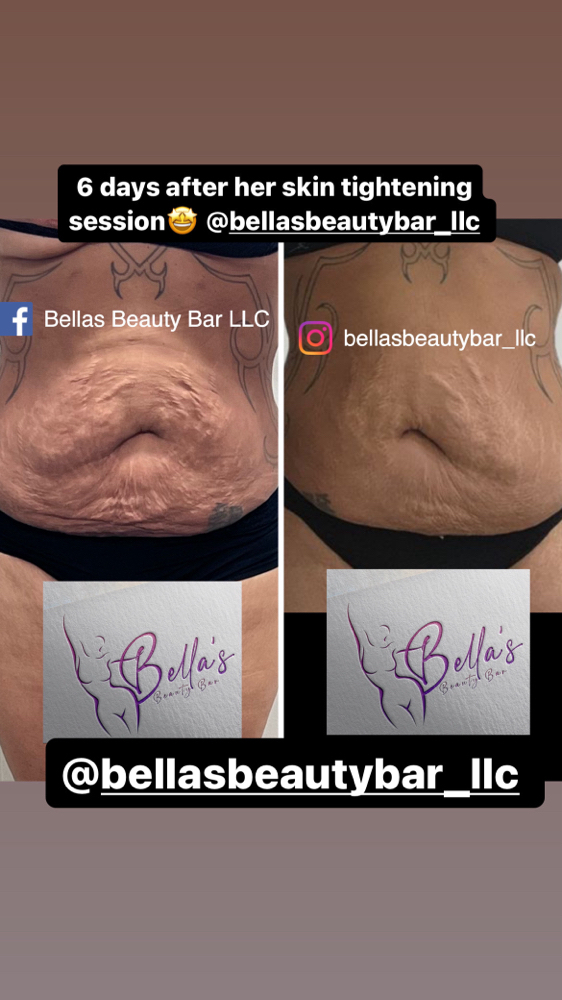 Bella's Skin Tightening
