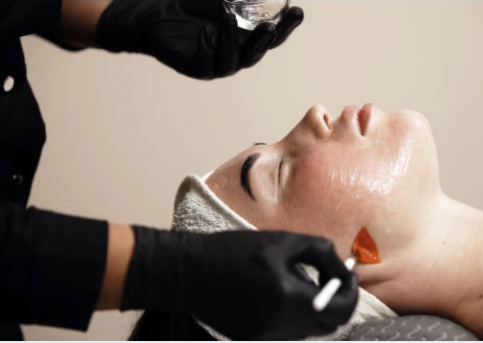 Chemical Peel at Wave Wellness & Aesthetics RBNY in Belle harbor, NY