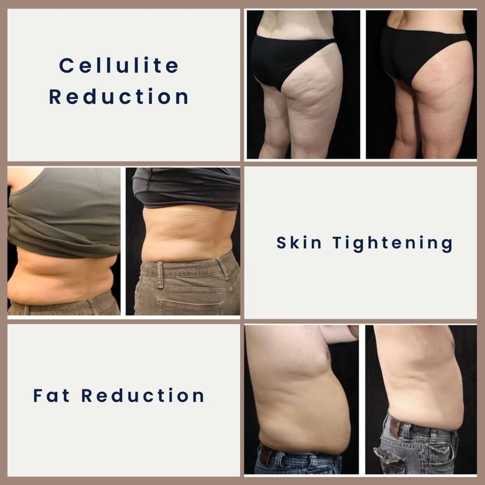 Consultation For BTL Cellutone at Advanced Aesthetics & Lash Studio in Salem, OR