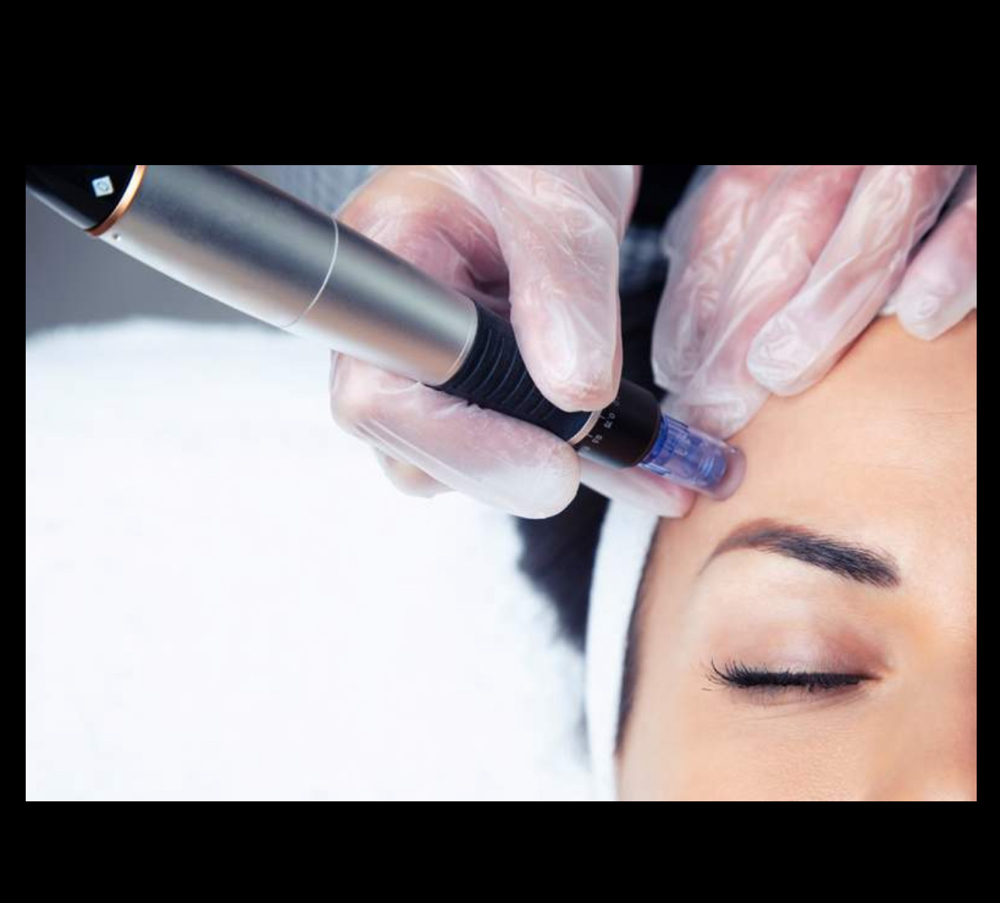 Microneedling
