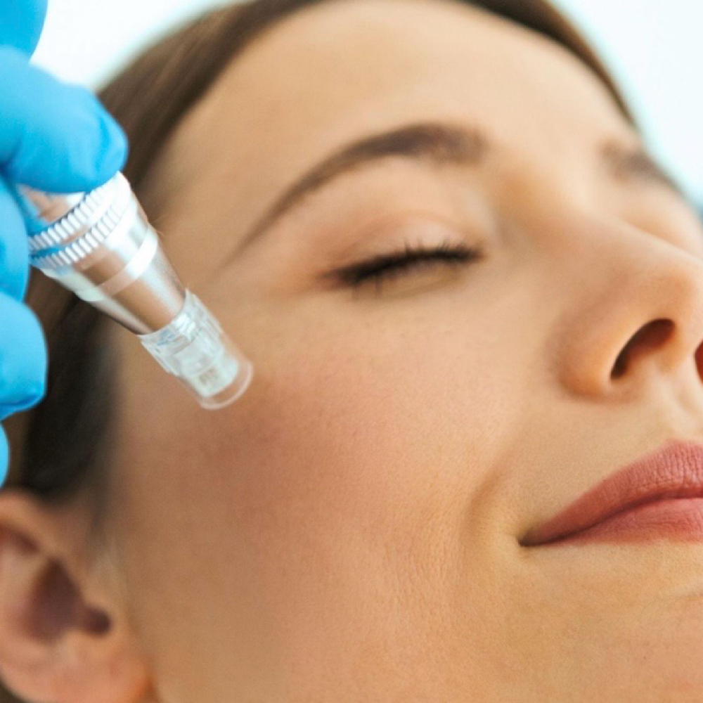 Microneedling w/ hyaluronic acid at Drip & Glow - By Ciera, RN