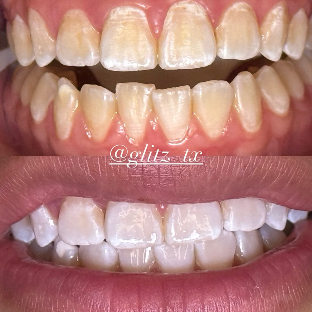TEEN WHITENING at Glitz_Tx in San Antonio, TX