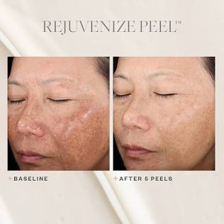 Rejuvanize Peel By SkinMedica