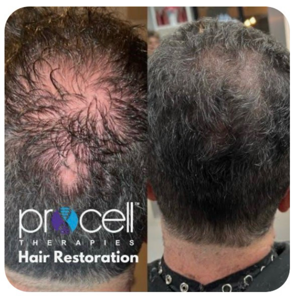 Procell™️ MD Hair Restoration at Ethereal Esthetics in Waialua, HI