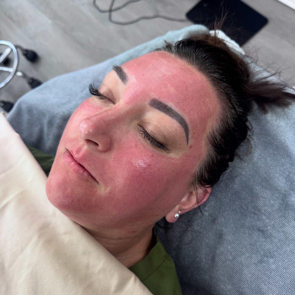 Microneedling Facial