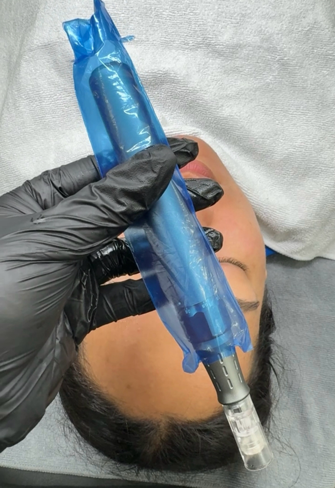 Microneedling Facial