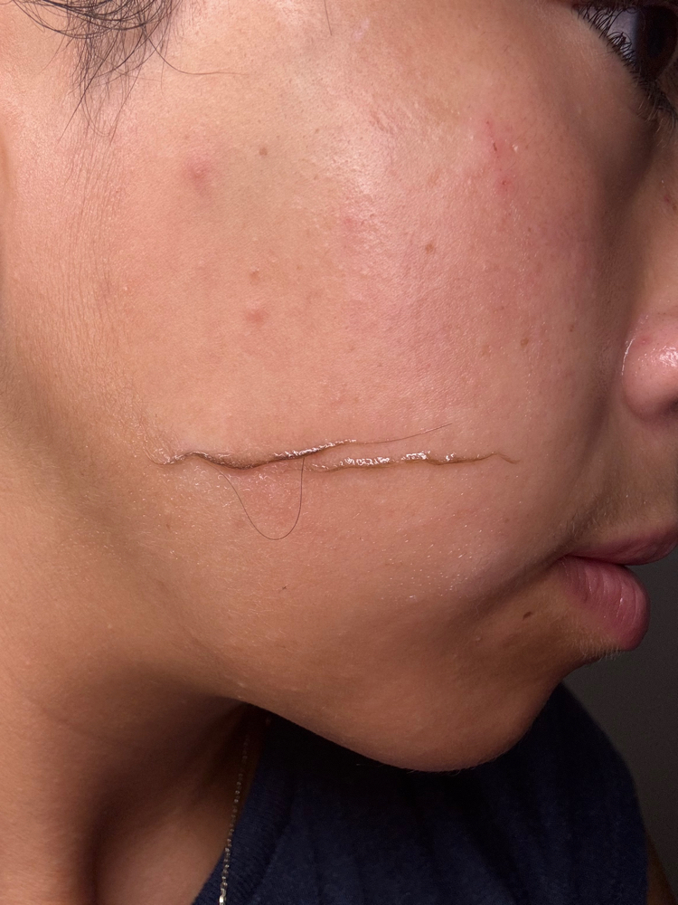 Dermaplaning Facial