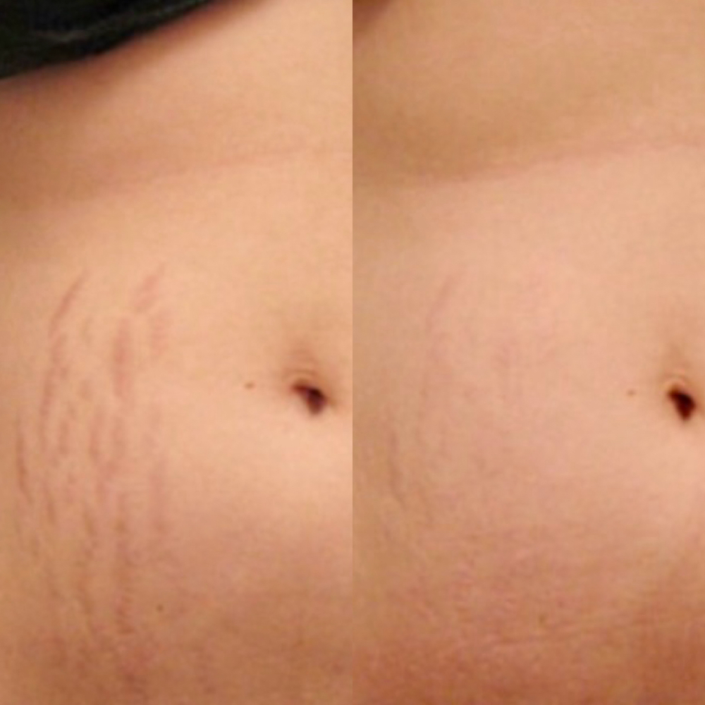 Growth Factor Stretchmark Revisio