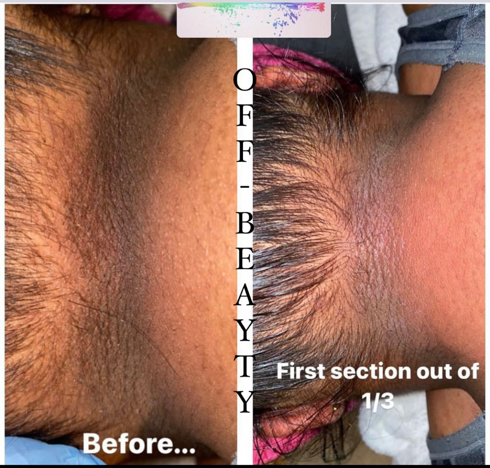 NeckPeeling/Despigmentacion Cuello