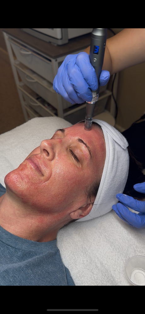 Microneedling