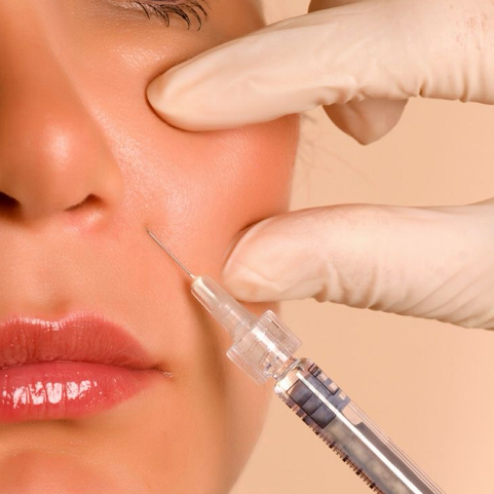 ✨ NASOLABIAL FOLDS at RGV PRIME AESTHETICS PLLC in Mcallen, TX