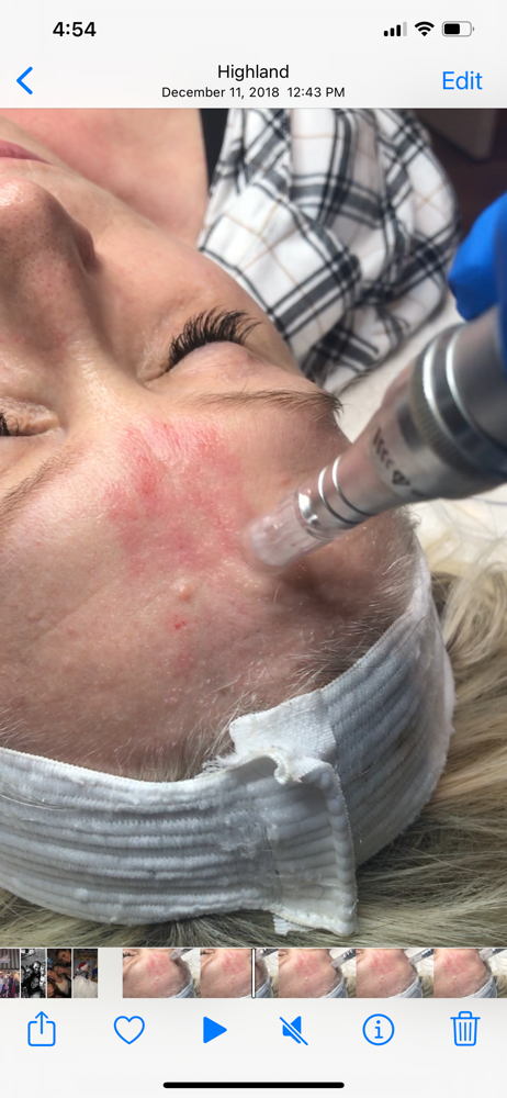 Microneedling